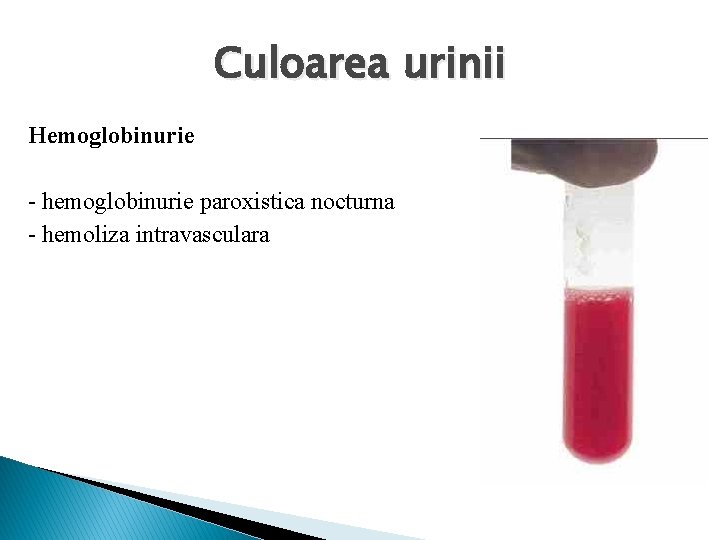 Culoarea urinii Hemoglobinurie - hemoglobinurie paroxistica nocturna - hemoliza intravasculara 
