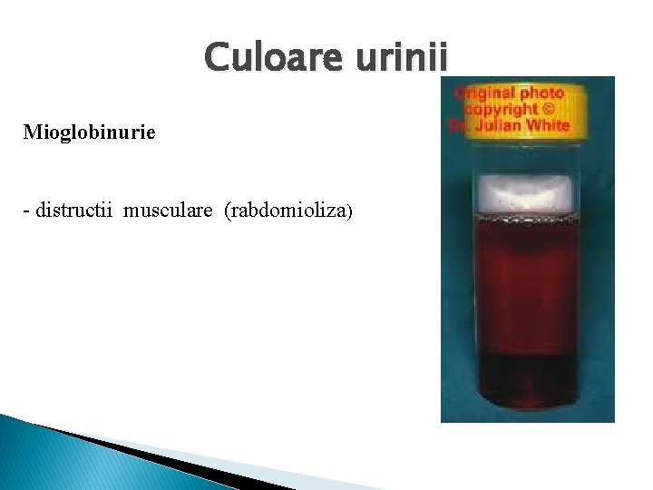 Culoare urinii Mioglobinurie - distructii musculare (rabdomioliza) 