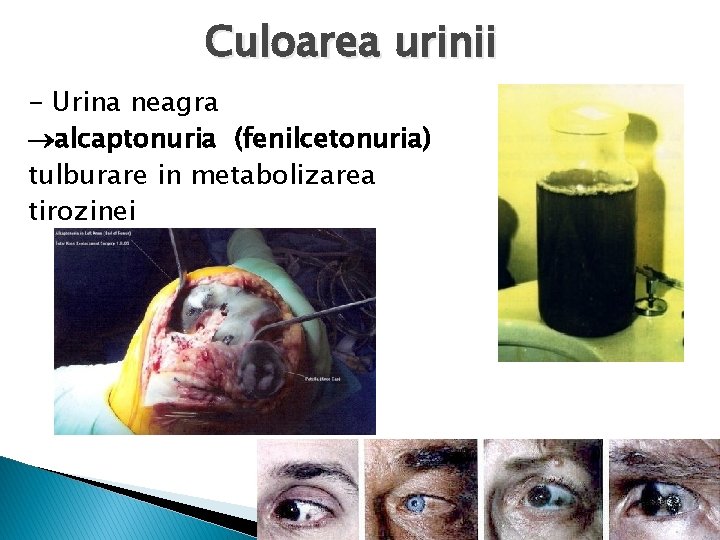 Culoarea urinii - Urina neagra alcaptonuria (fenilcetonuria) tulburare in metabolizarea tirozinei 