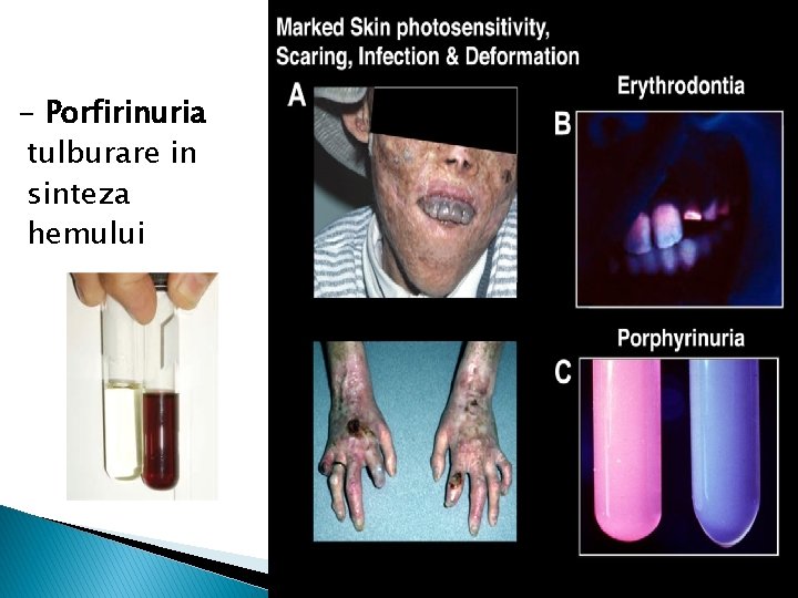 - Porfirinuria tulburare in sinteza hemului 