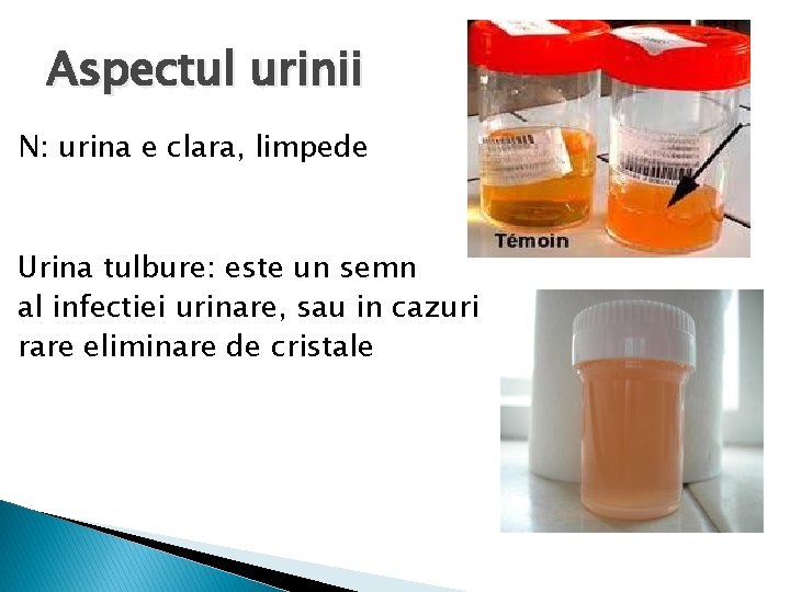 Aspectul urinii N: urina e clara, limpede Urina tulbure: este un semn al infectiei