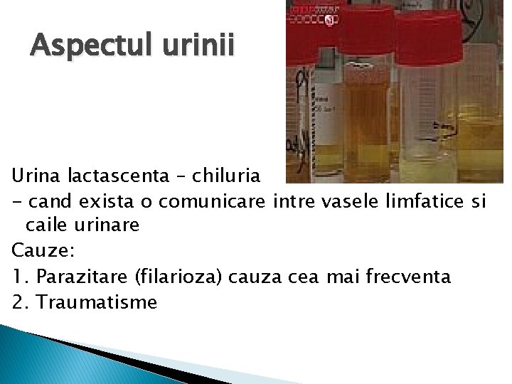 Aspectul urinii Urina lactascenta – chiluria - cand exista o comunicare intre vasele limfatice