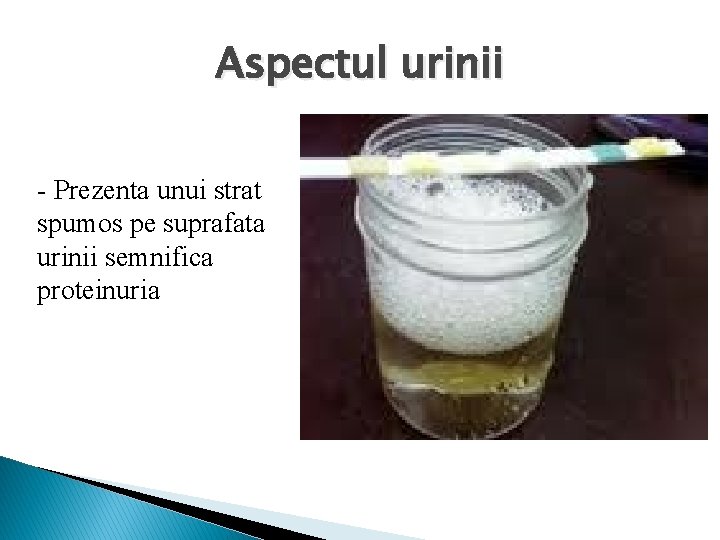 Aspectul urinii - Prezenta unui strat spumos pe suprafata urinii semnifica proteinuria 