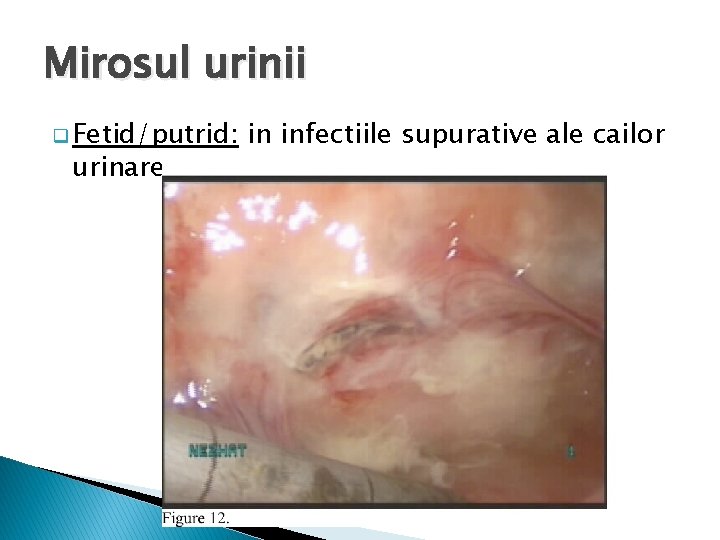 Mirosul urinii q Fetid/putrid: urinare in infectiile supurative ale cailor 