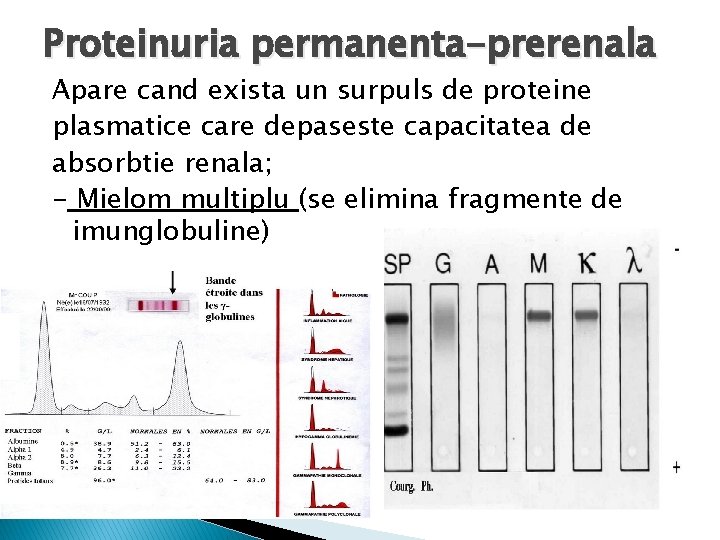 Proteinuria permanenta-prerenala Apare cand exista un surpuls de proteine plasmatice care depaseste capacitatea de