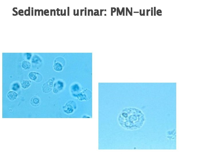 Sedimentul urinar: PMN-urile 