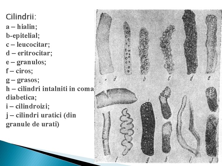 Cilindrii: a – hialin; b-epitelial; c – leucocitar; d – eritrocitar; e – granulos;