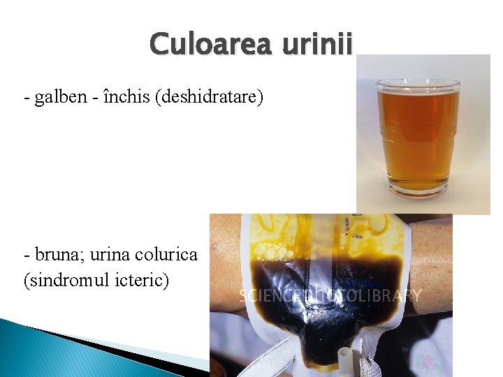 Culoarea urinii - galben - închis (deshidratare) - bruna; urina colurica (sindromul icteric) 