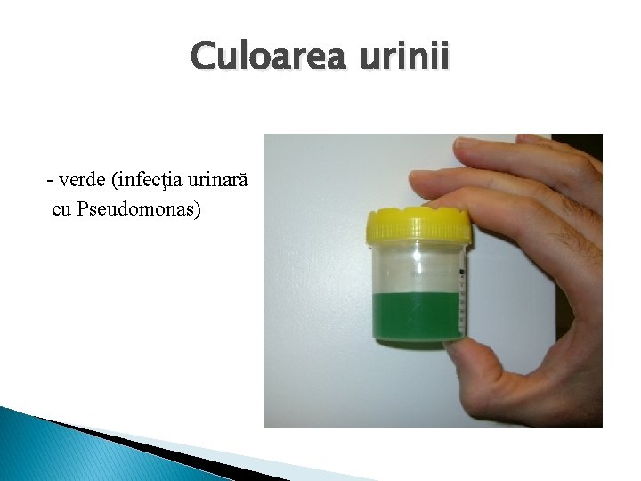 Culoarea urinii - verde (infecţia urinară cu Pseudomonas) 