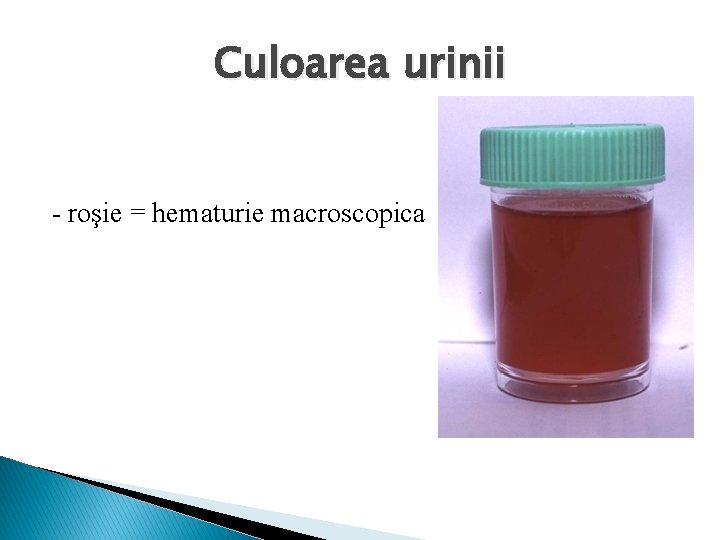 Culoarea urinii - roşie = hematurie macroscopica 