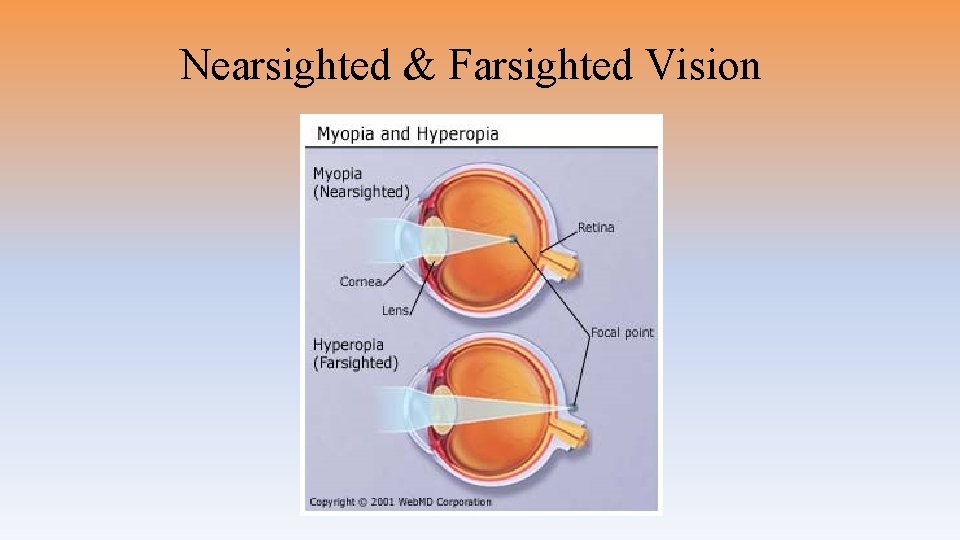 Nearsighted & Farsighted Vision 