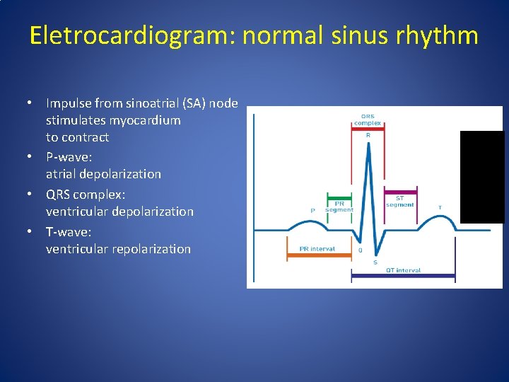 Eletrocardiogram: normal sinus rhythm • Impulse from sinoatrial (SA) node stimulates myocardium to contract Eletrocardiogram: normal sinus rhythm • Impulse from sinoatrial (SA) node stimulates myocardium to contract