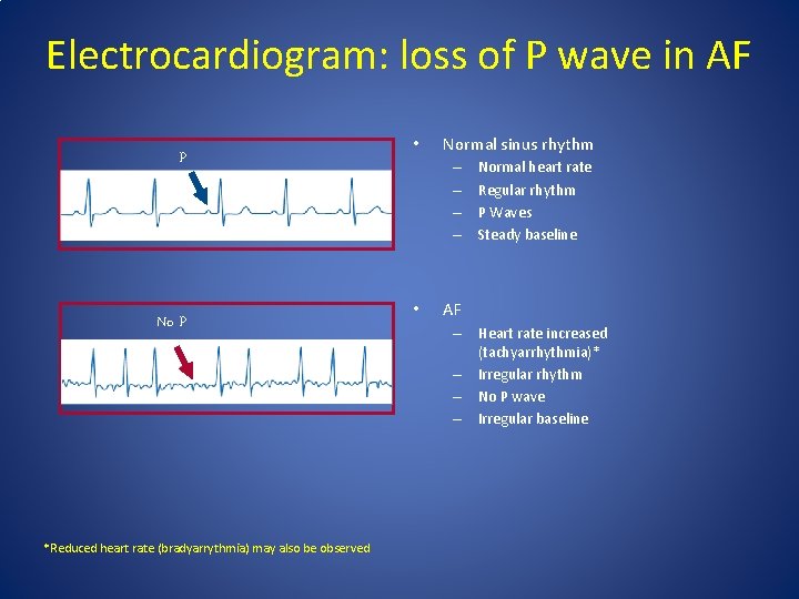Electrocardiogram: loss of P wave in AF P No P *Reduced heart rate (bradyarrythmia) Electrocardiogram: loss of P wave in AF P No P *Reduced heart rate (bradyarrythmia)