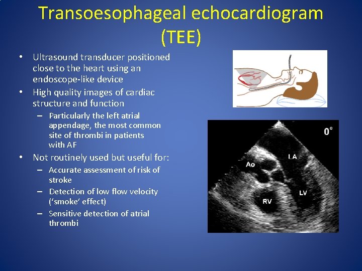 Transoesophageal echocardiogram (TEE) • Ultrasound transducer positioned close to the heart using an endoscope-like Transoesophageal echocardiogram (TEE) • Ultrasound transducer positioned close to the heart using an endoscope-like