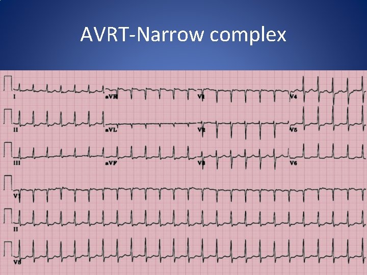 AVRT-Narrow complex AVRT-Narrow complex