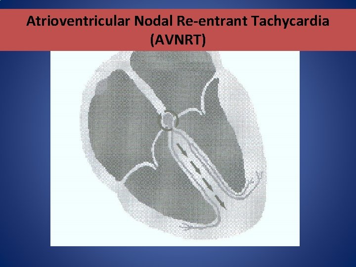 Atrioventricular Nodal Re-entrant Tachycardia (AVNRT) Atrioventricular Nodal Re-entrant Tachycardia (AVNRT)