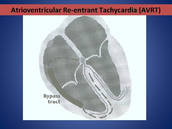 Atrioventricular Re-entrant Tachycardia (AVRT) Atrioventricular Re-entrant Tachycardia (AVRT)