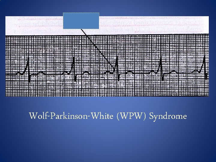 Wolf-Parkinson-White (WPW) Syndrome Wolf-Parkinson-White (WPW) Syndrome