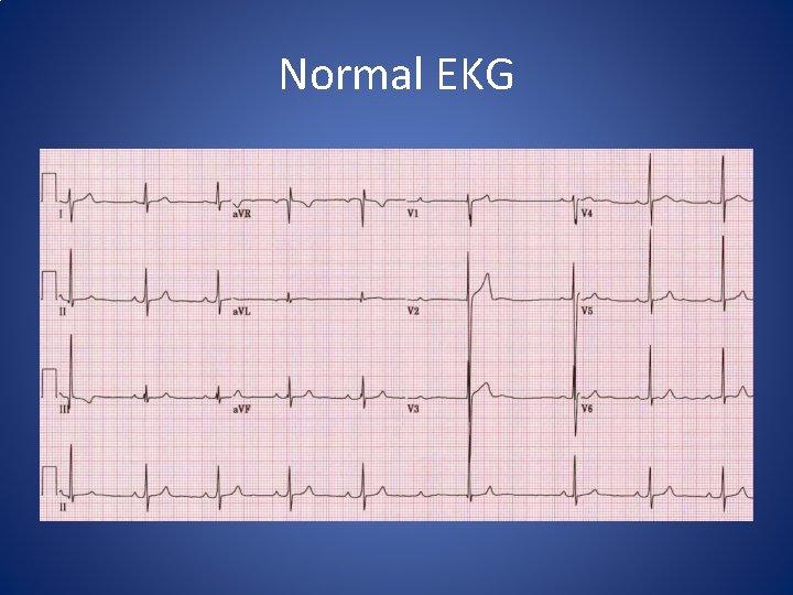 Normal EKG Normal EKG