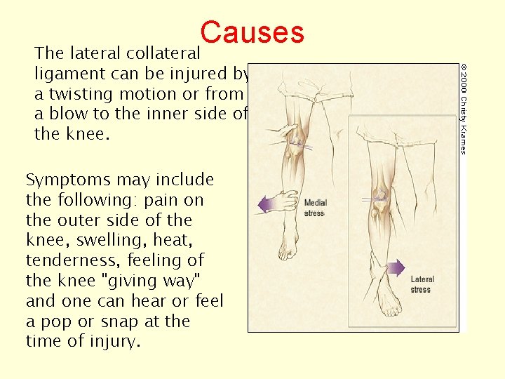 Causes The lateral collateral ligament can be injured by a twisting motion or from