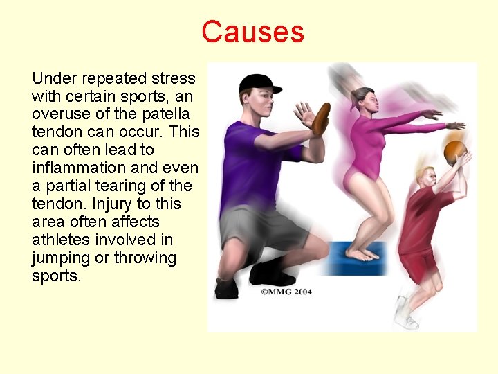 Causes Under repeated stress with certain sports, an overuse of the patella tendon can