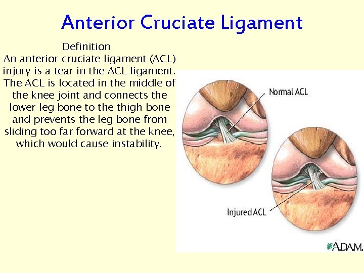 Anterior Cruciate Ligament Definition An anterior cruciate ligament (ACL) injury is a tear in