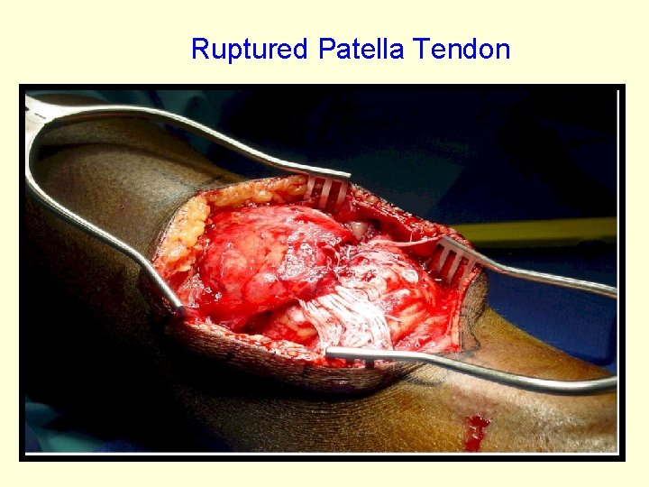 Ruptured Patella Tendon 