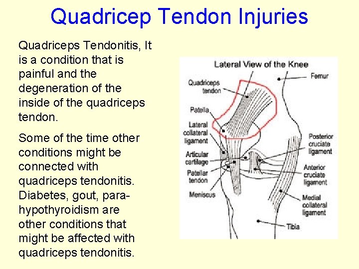 Quadricep Tendon Injuries Quadriceps Tendonitis, It is a condition that is painful and the
