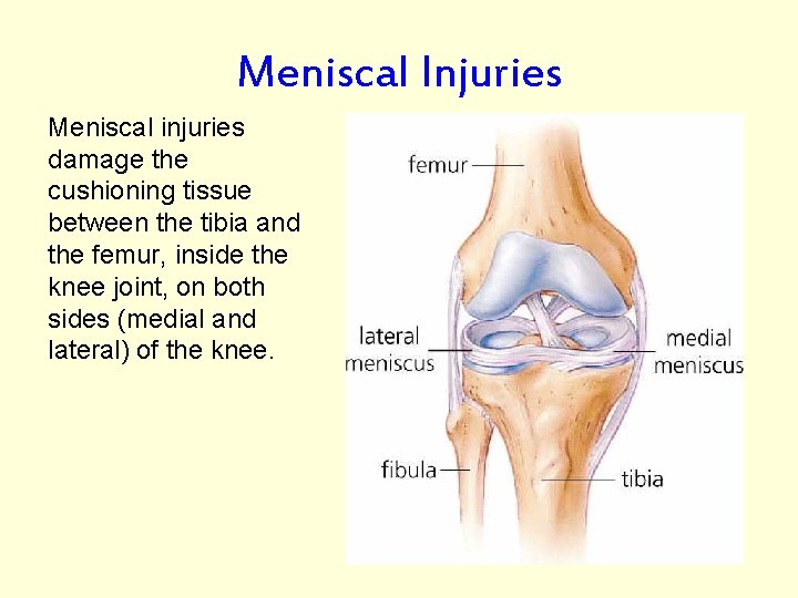 Meniscal Injuries Meniscal injuries damage the cushioning tissue between the tibia and the femur,