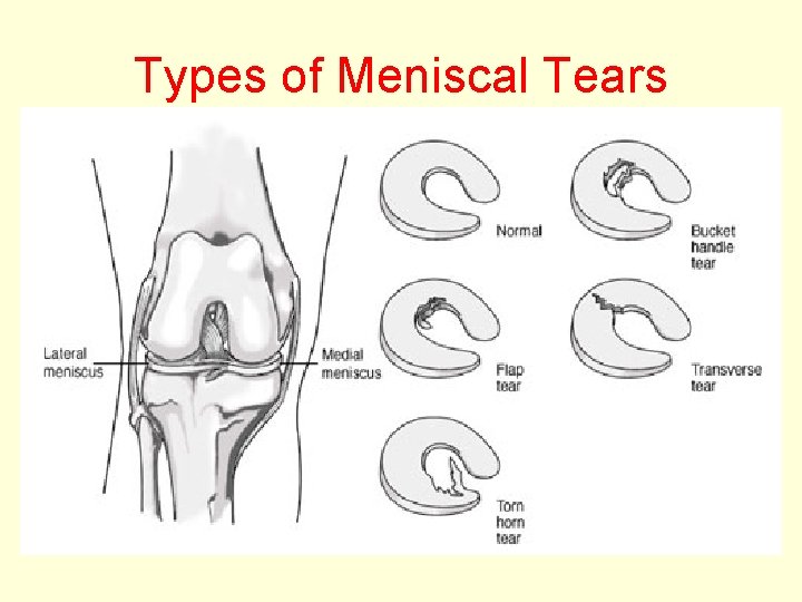 Types of Meniscal Tears 