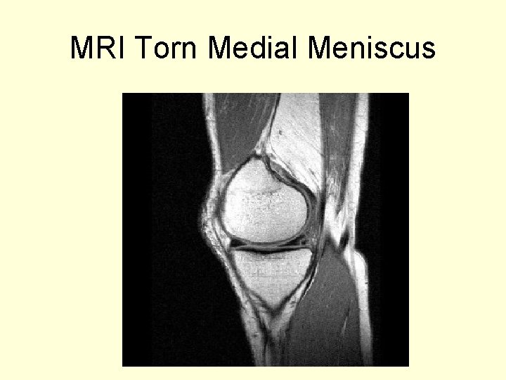 MRI Torn Medial Meniscus 