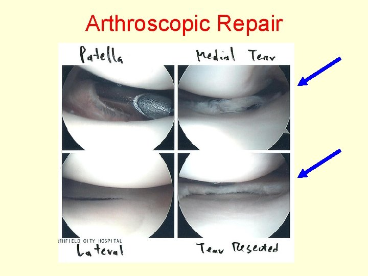 Arthroscopic Repair 