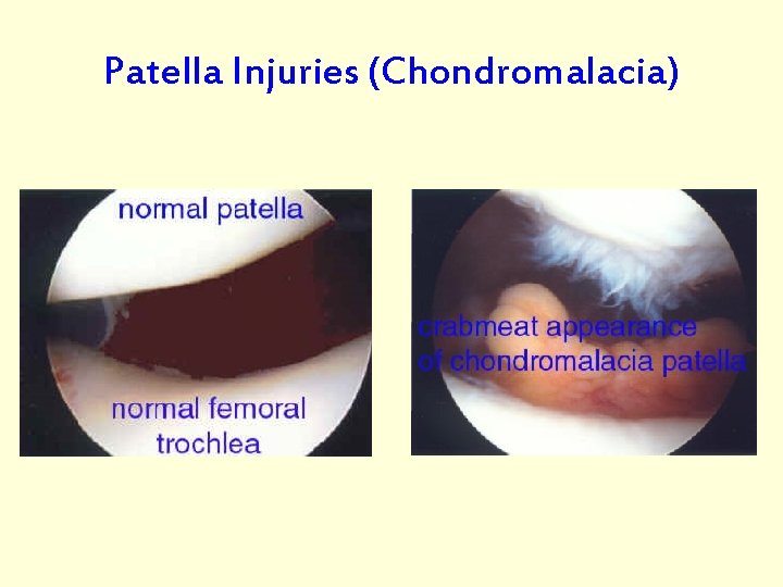 Patella Injuries (Chondromalacia) 
