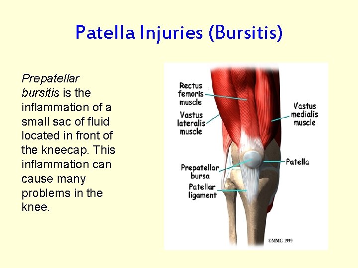 Patella Injuries (Bursitis) Prepatellar bursitis is the inflammation of a small sac of fluid