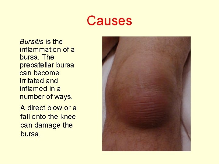 Causes Bursitis is the inflammation of a bursa. The prepatellar bursa can become irritated