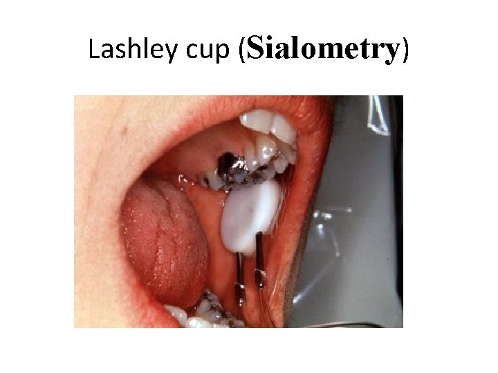 Lashley cup (Sialometry) 