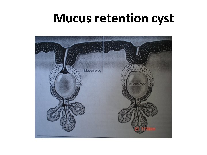 Mucus retention cyst 
