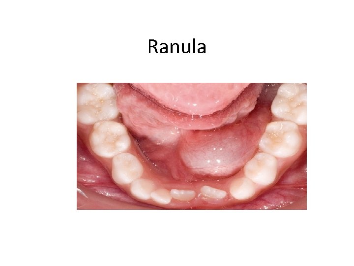 Ranula 