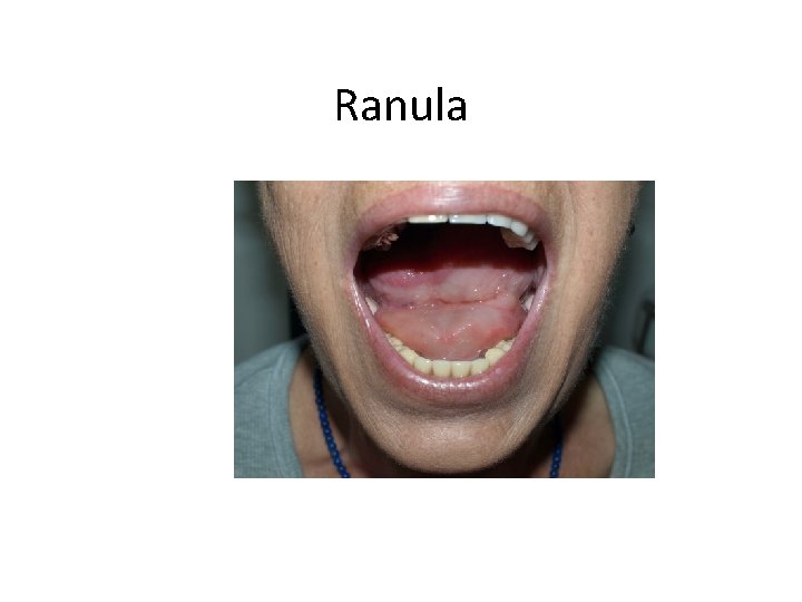 Ranula 