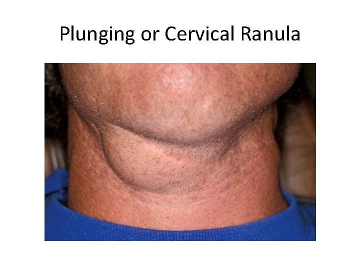 Plunging or Cervical Ranula 