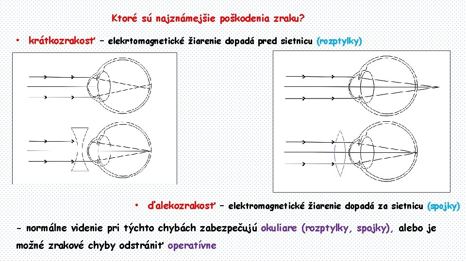 Ktoré sú najznámejšie poškodenia zraku? • krátkozrakosť – elekrtomagnetické žiarenie dopadá pred sietnicu (rozptylky)