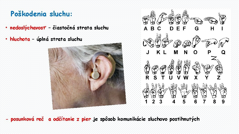 Poškodenia sluchu: • nedoslýchavosť – čiastočná strata sluchu • hluchota – úplná strata sluchu