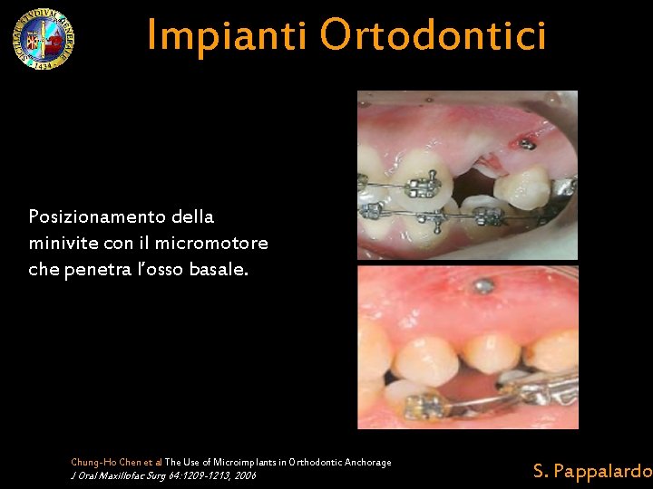 Impianti Ortodontici Posizionamento della minivite con il micromotore che penetra l’osso basale. Chung-Ho Chen