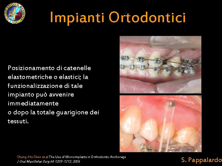 Impianti Ortodontici Posizionamento di catenelle elastometriche o elastici; la funzionalizzazione di tale impianto può