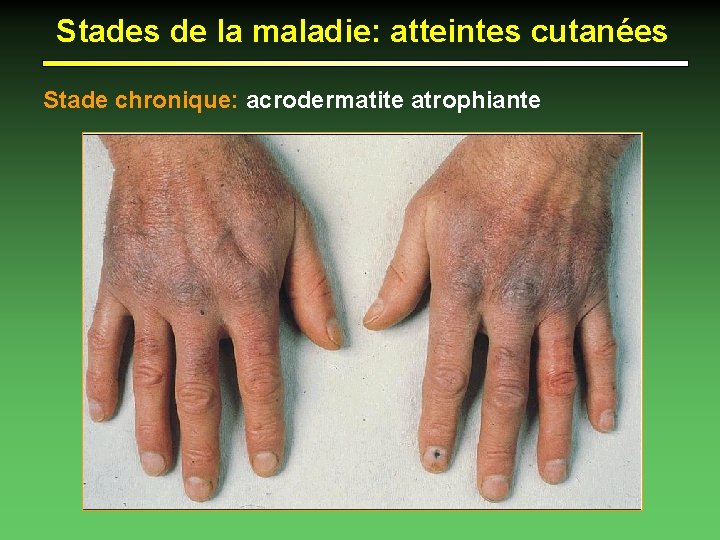 Stades de la maladie: atteintes cutanées Stade chronique: acrodermatite atrophiante 
