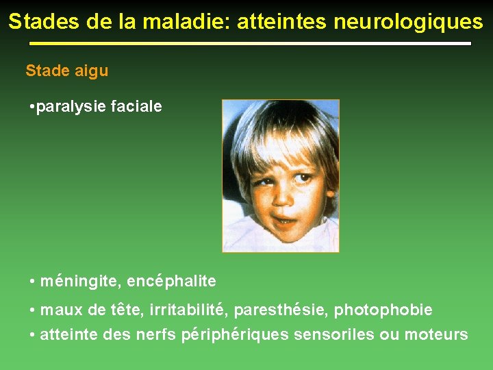Stades de la maladie: atteintes neurologiques Stade aigu • paralysie faciale • méningite, encéphalite