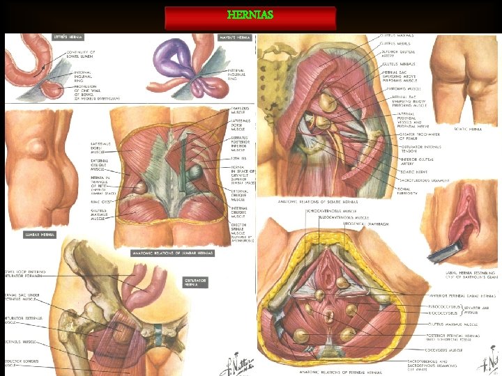 HERNIAS 