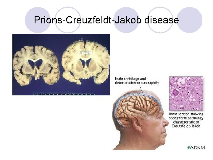 Prions-Creuzfeldt-Jakob disease 