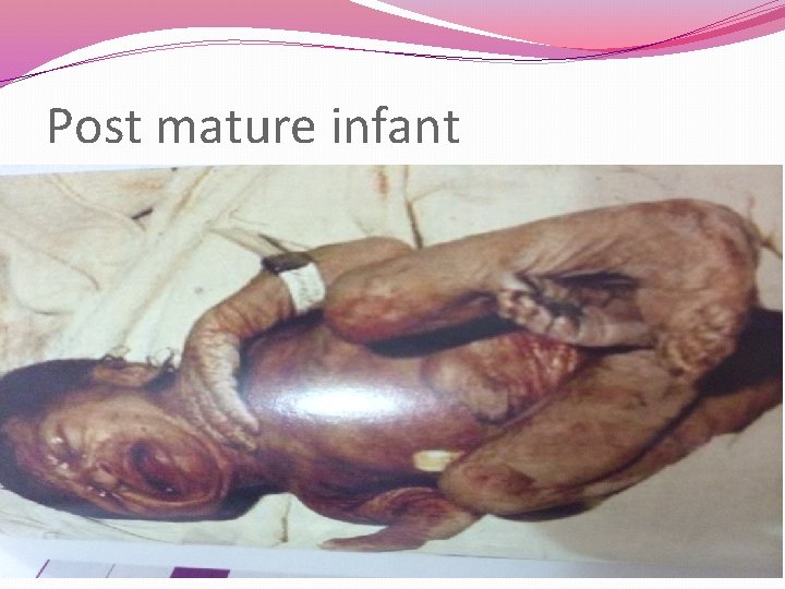 Post mature infant 