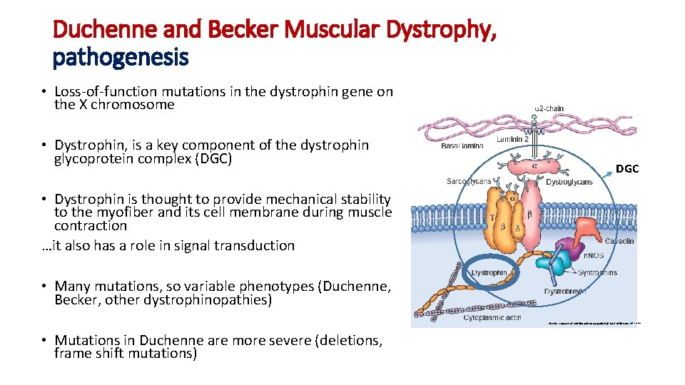 Duchenne and Becker Muscular Dystrophy, pathogenesis • Loss-of-function mutations in the dystrophin gene on